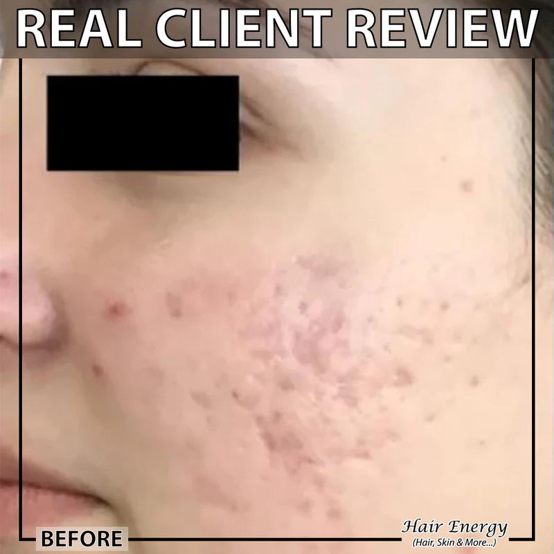 Derma Roller System 0.5 Mm Hair & Skin Care