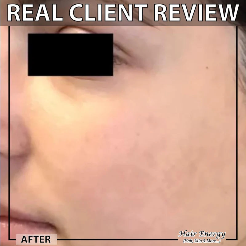 Derma Roller System 0.5 Mm Hair & Skin Care